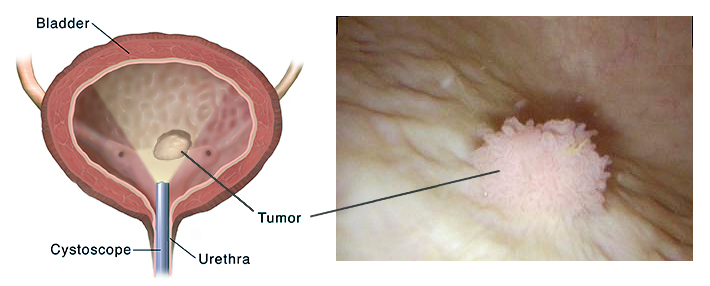 bladder cancer